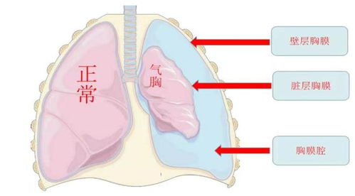 爆肺是什么? 爆肺是什么?