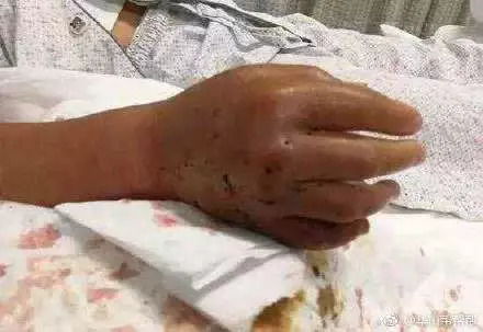 老人被毒蛇咬伤：医生说比骨折还痛(老人被毒蛇咬伤，痛楚超越骨折的严峻警示)