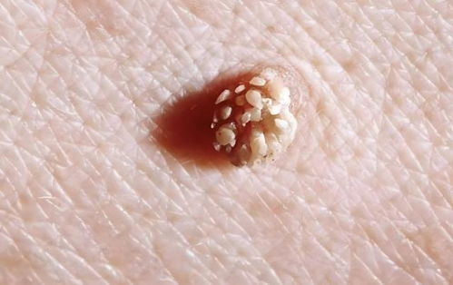 男子手上长肉芽剪掉又长疑感染HPV