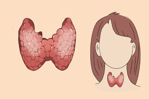 女生确诊甲状腺癌 朋友称其阳光抑郁