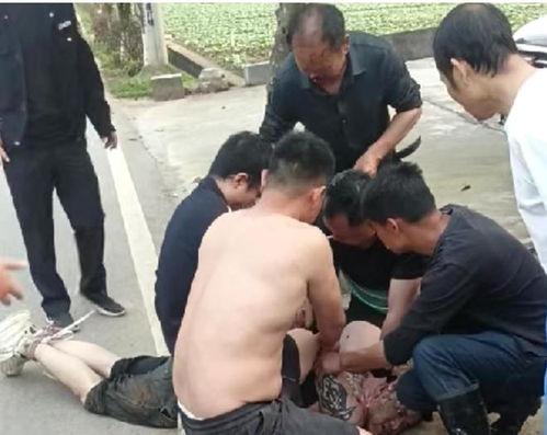 被歹徒咬掉鼻子老人缝了115针